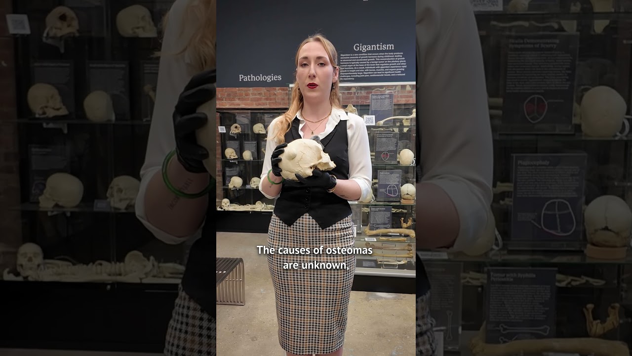 What is a Giant Osteoma?