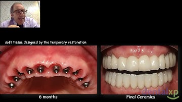 Modern Approach of Full Arch Immediate Loading