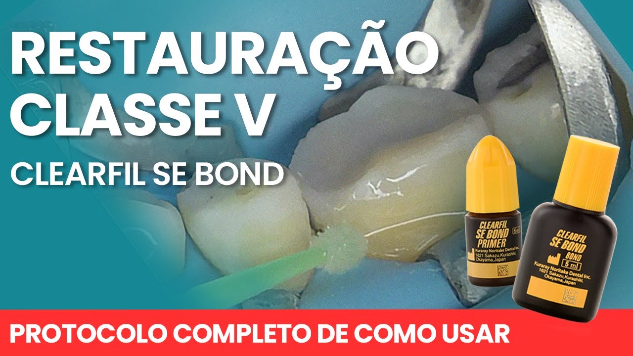 CLEARFIL SE BOND RESTAURAÇÃO CLASSE V - Mylene e Renato