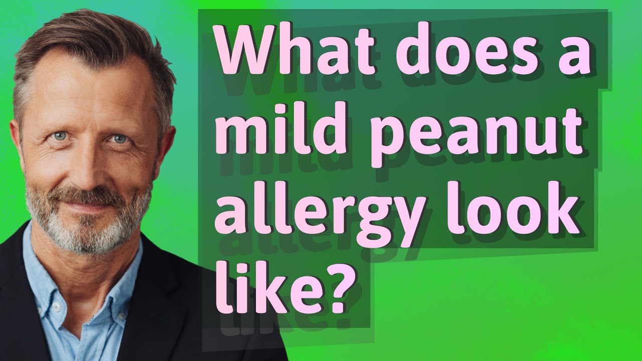 What Does A Mild Peanut Allergy Look Like YouTube What Does A Mild Peanut Allergy Look Like YouTube