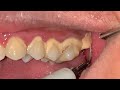 KARANG GIGI GERAHAM ATAS | Dentist | Dokter Gigi Tri Putra