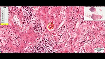 Lymph node: Metastatic carcinoma