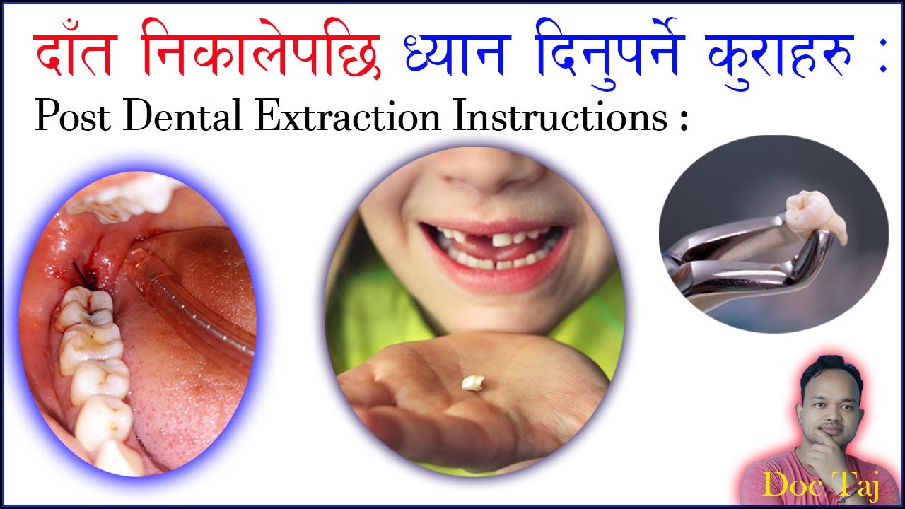 दाँत निकालेपछि ध्यान दिनुपर्ने कुराहरु/ Post Dental extraction