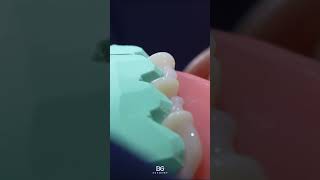 Temporary veneers. Artistic moments. #veneer #veneers #temporaryveneers #dentaleducations