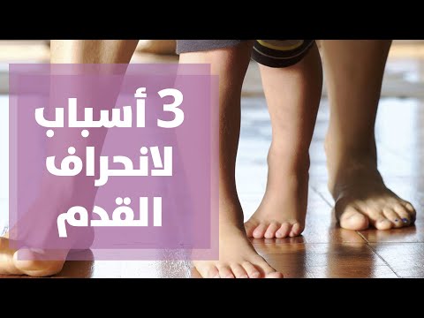 فيديو: طيات غير متكافئة على أرجل الطفل: القاعدة أو الانحراف