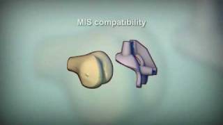 Simplified Knee Surgery with Patient Specific Instruments