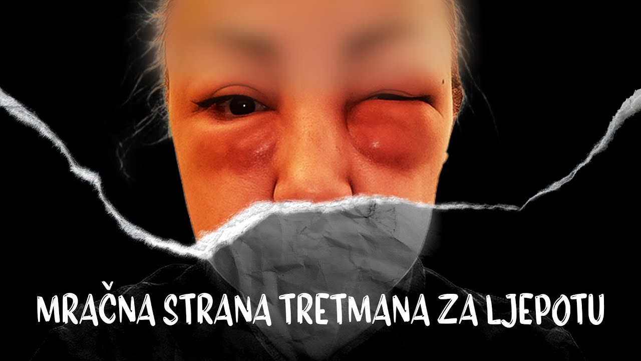 Mračna strana tretmana za ljepotu