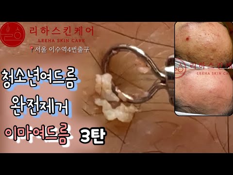 청소년 여드름 압출 3탄