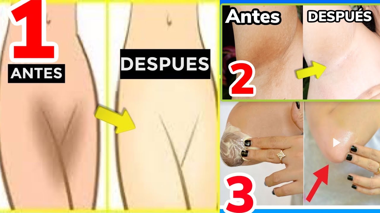 Cuantas sesiones de laser se necesitan para las axilas