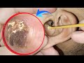 WARNING: Deep, Infected Earwax Removal That Will Shock You | ASMR Ear Cleaning USA | Ep82