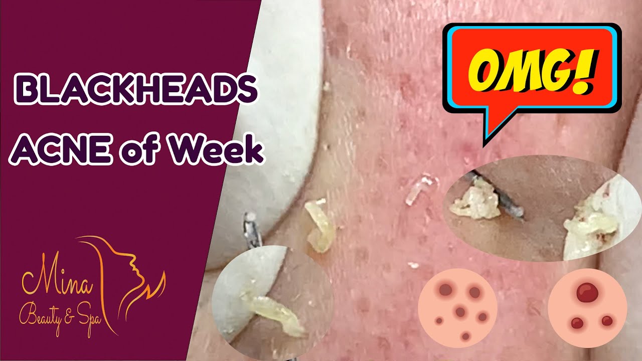 Ga Spa Videos For Removal Of Blackheads