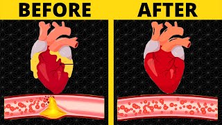 top 8 foods that unclog arteries naturally and prevent heart attack