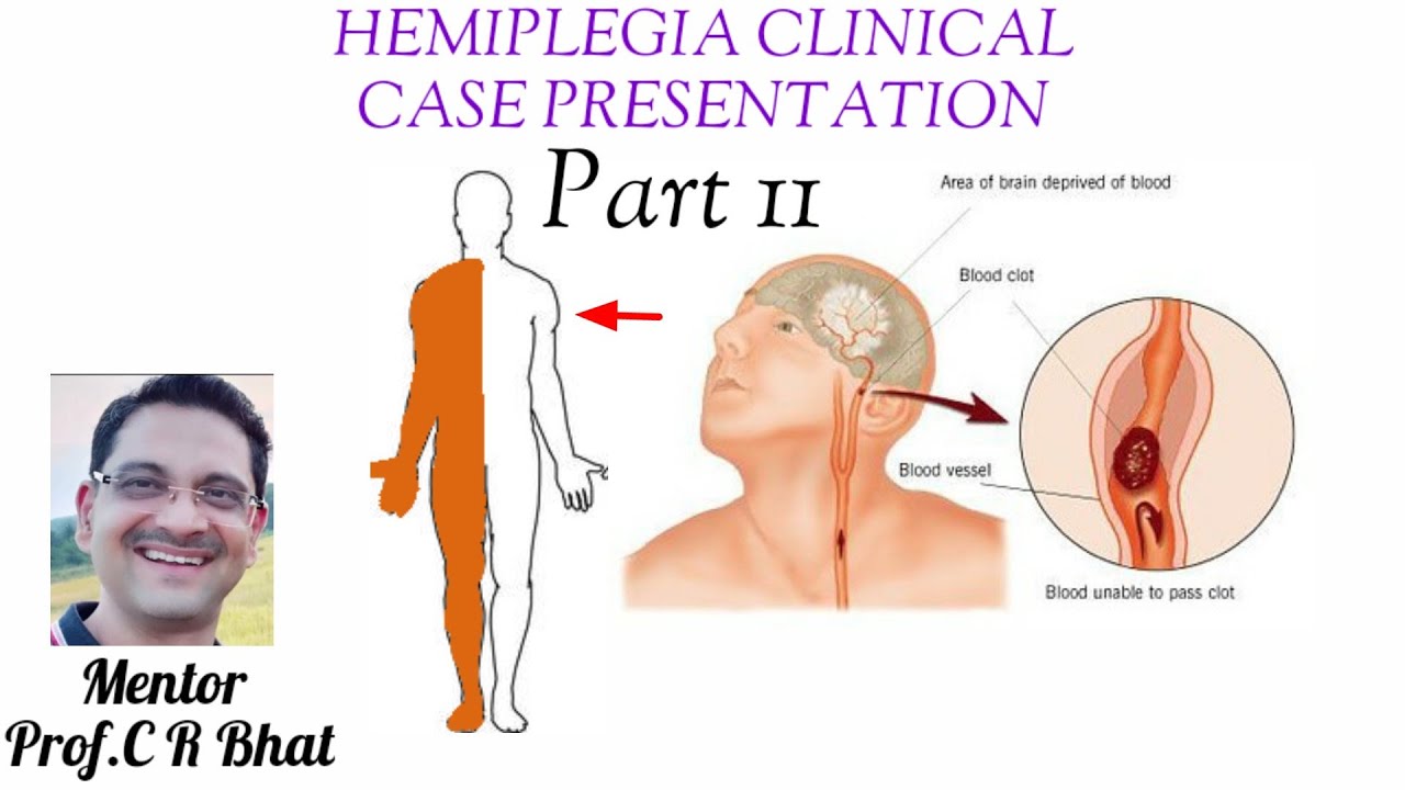 hemiplegia case presentation slideshare
