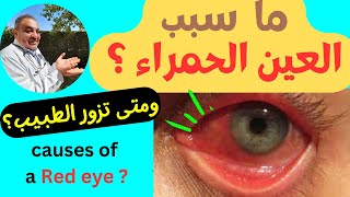 احمرار العين وعلاجه |   لماذا يزداد احمرار العين في الصيف ؟