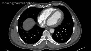 Segmental And Subsegmental Pe