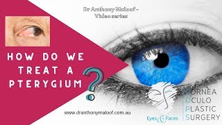 How do we treat a Pterygium - Pterygium Surgery - Dr Anthony Maloof Sydney, Australia
