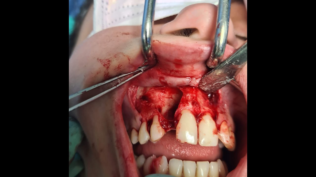FOLLICULAR CYST WITH IMPACTED CANINE AND MAXILLARY LATERAL INCISOR ...