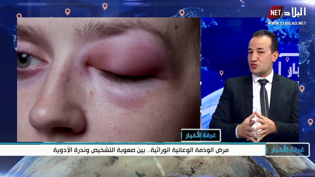 مرض الوذمة الوعائية الوراثية ..بين صعوبة التشخيص و ندرة الأدوية