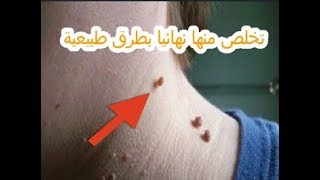 أسباب الزوائد الجلدية( الثالول)وأفضل طريقة للتخلص منها بشكل نهائى!