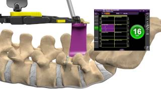 MAS PLIF Patient Education Animation US