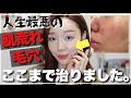 【Qoo10】毛穴•ニキビ•肌荒れ…ボロボロから卵肌😳韓国もレチノールがバズり中👏【ナンバーズイン】