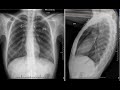 pneumomediastinum