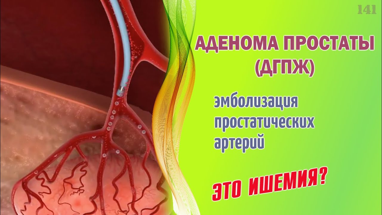 Аденома простаты. Лечение эмболизацией артерий. Это ишемия? - YouTube