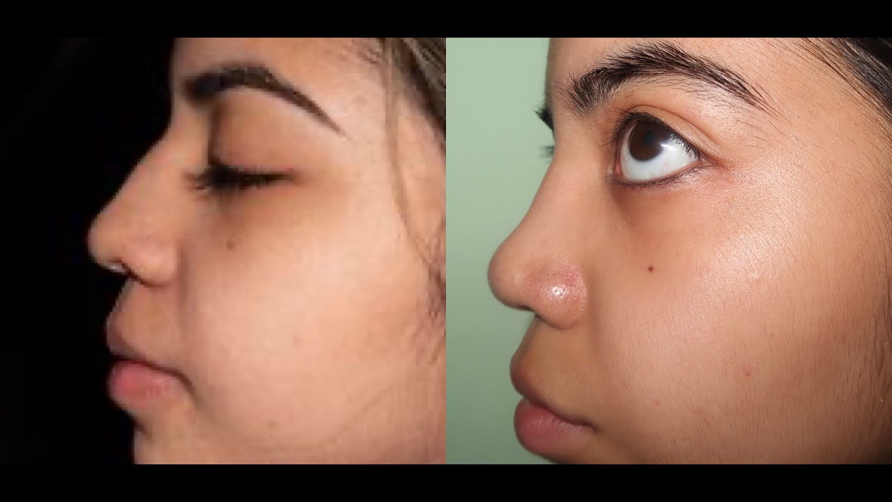 I GOT A CHEAP NOSE JOB IN ECUADOR! Shantellllxo YouTube