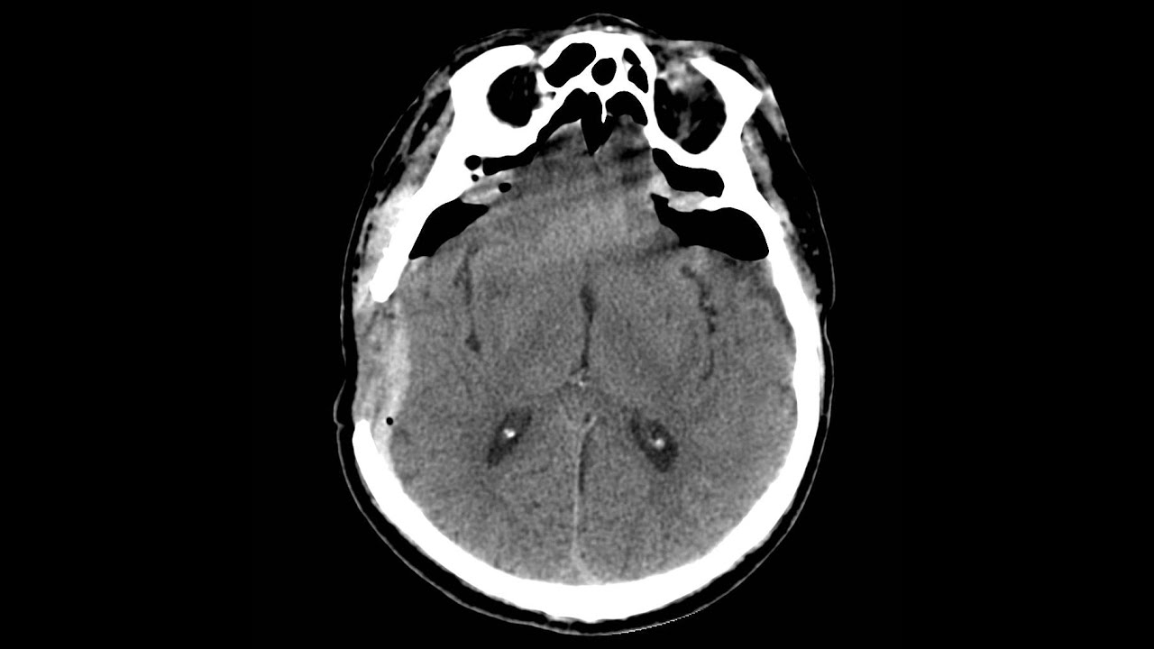 Состояние после трепанации черепа. Пневмоцефалия - YouTube
