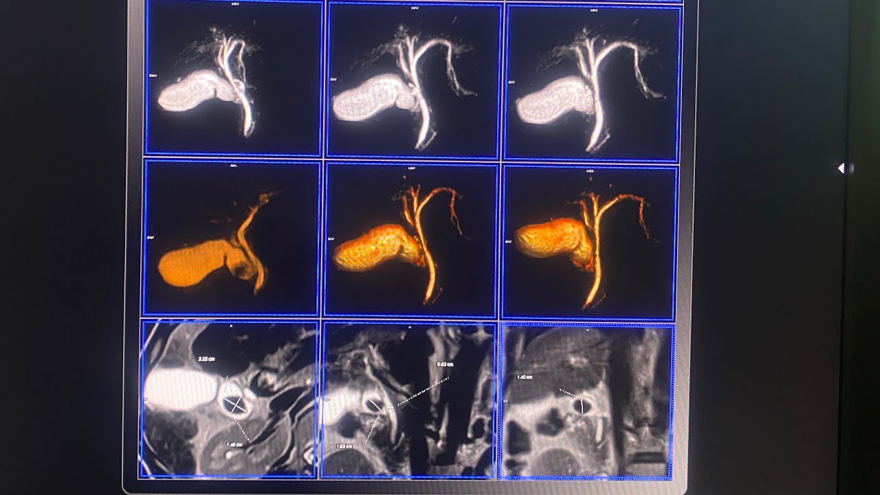 رنين مغناطيسي علي القناه  المراريه بدون صبغه Magnetic Resonance Cholangiopancreatography (MRCP) 1.5T