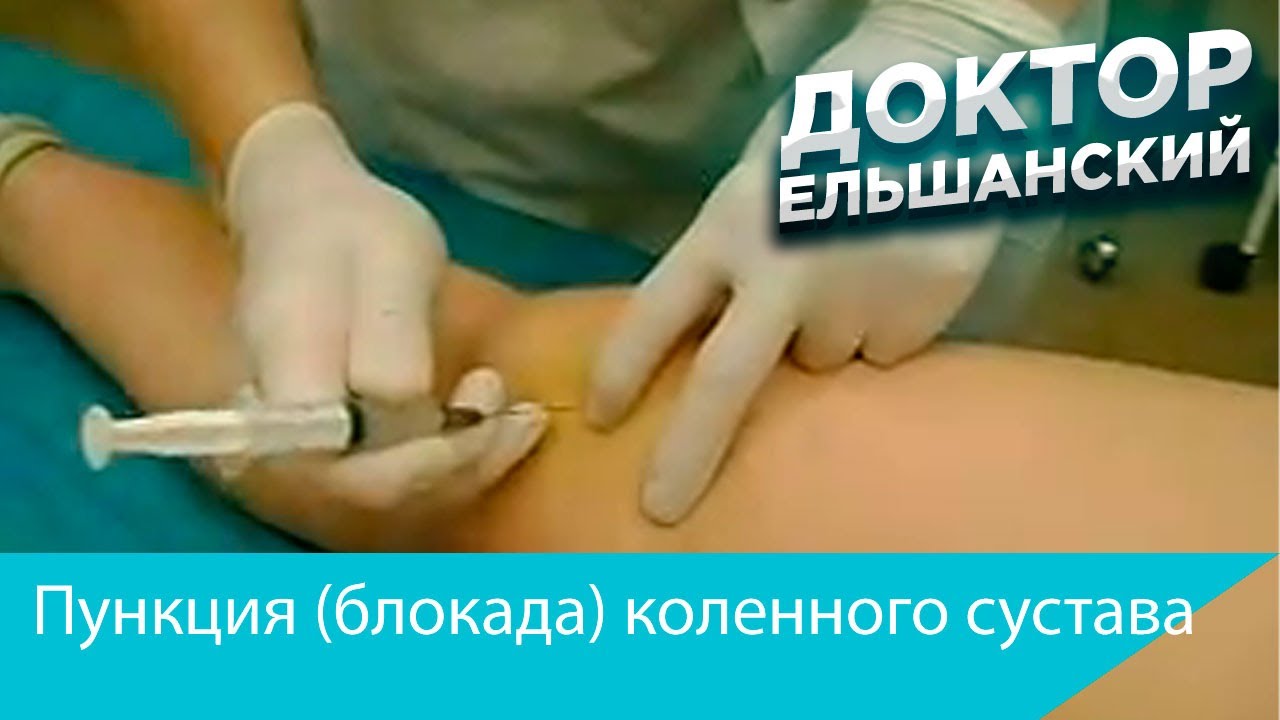 Пункция (блокада) коленного сустава
