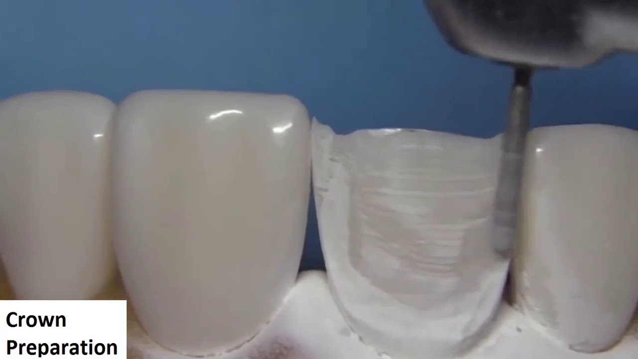 Crown Preparation YouTube