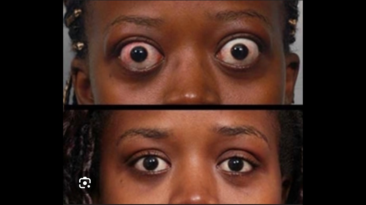 Tezi ya GOITA na athari zake kwa Afya ya mwanamke miaka 35+. Macho kutoka nnje, uzito na mood swings