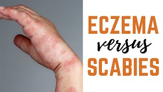 Scabies vs. Eczema: Causes, Symptoms & Treatments