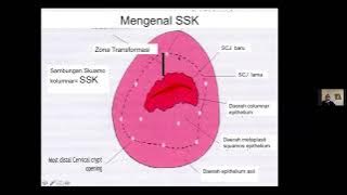 Deteksi Dini Kanker Leher Rahim dengan Pemeriksaan IVA Test - dr. Andi Kurniadi, Sp.OG(K)-Onk.,MKes
