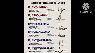 ECG with Electrolytes changes