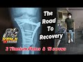 Road to recovery part 1  physical therapy  tibial plateau fracture