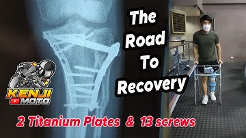 Road To Recovery Part 1 | Physical Therapy | Tibial Plateau Fracture