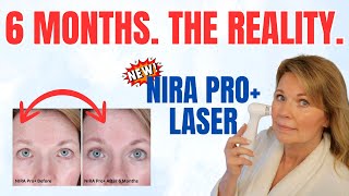 Is the NIRA PRO+ Laser Worth It? 6 Months Results | The Reality