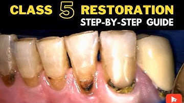 class V composite restoration procedure guide