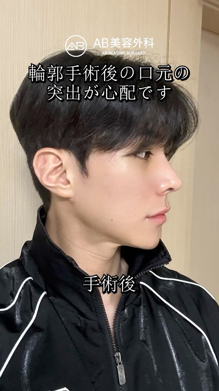 輪郭３点・口ゴボ・鼻整形で大変身✨ #Shorts