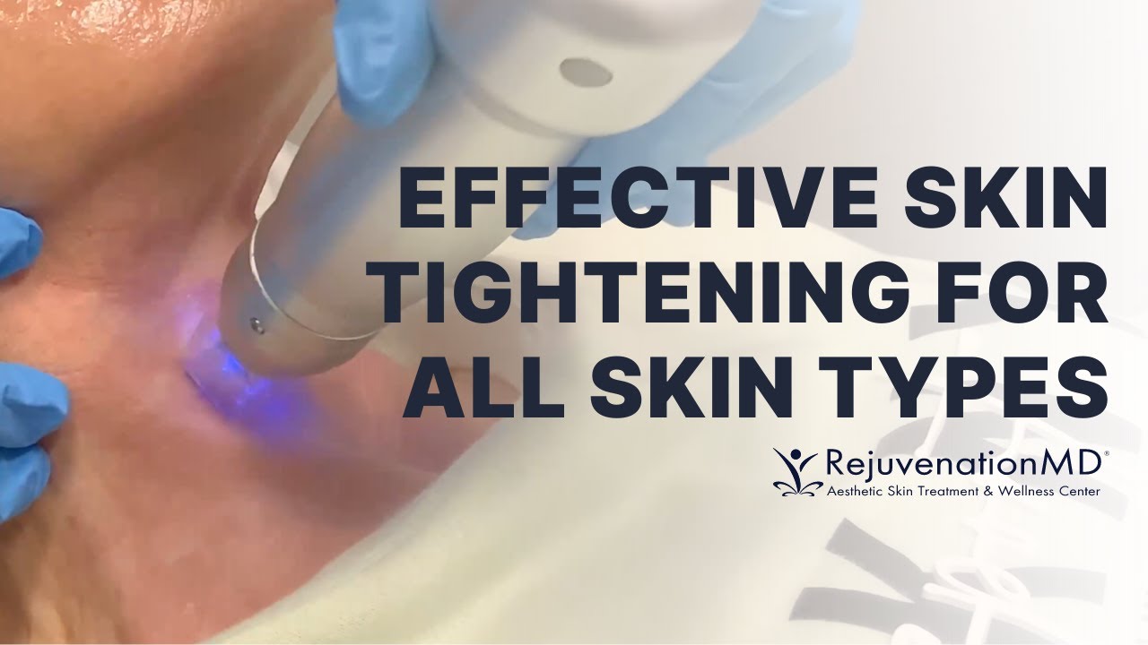 Superior Skin Tightening with Scarlet SRF | Watch Until the End for Before & Afters