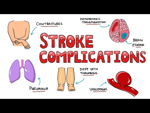 Post Stroke Complications - What are the most common complications of stroke?