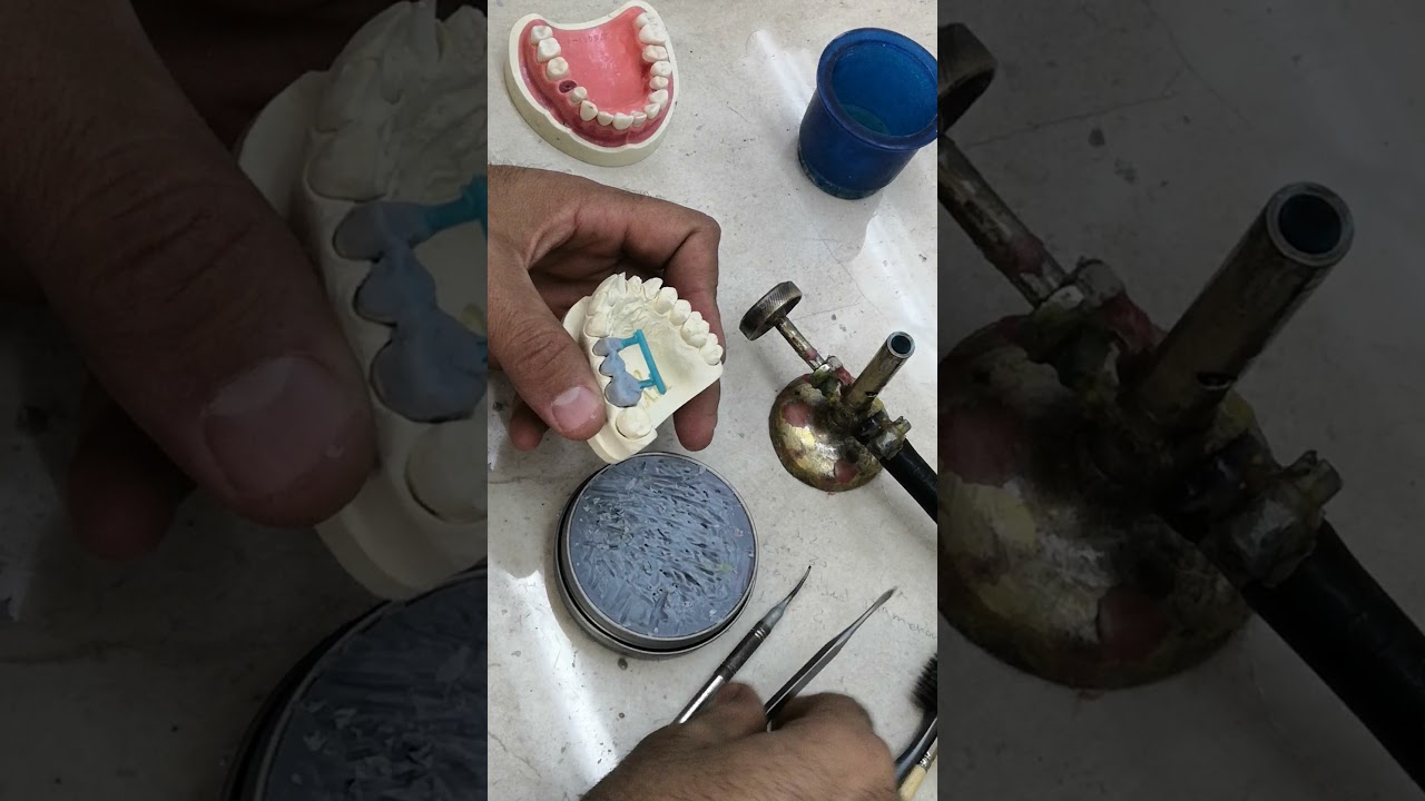 عمل الجسور ووضع السبرو واكس وصب المعدن _  make bridge and supro wax and casting_الدكتور مدحت عماوي