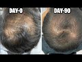 90 days hair regrowth result | minoxidil hair regrowth result | best minoxidil for hair regrowth |