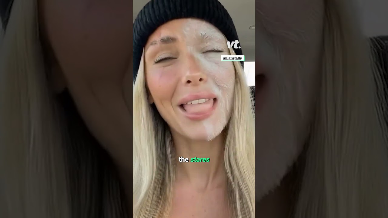 Интернет помешался на моем белом родимом пятне 😳