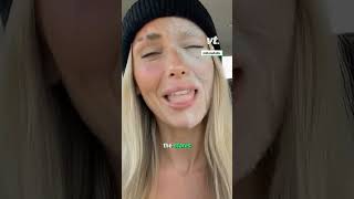 The Internet Is Obsessed With My White Birth Mark