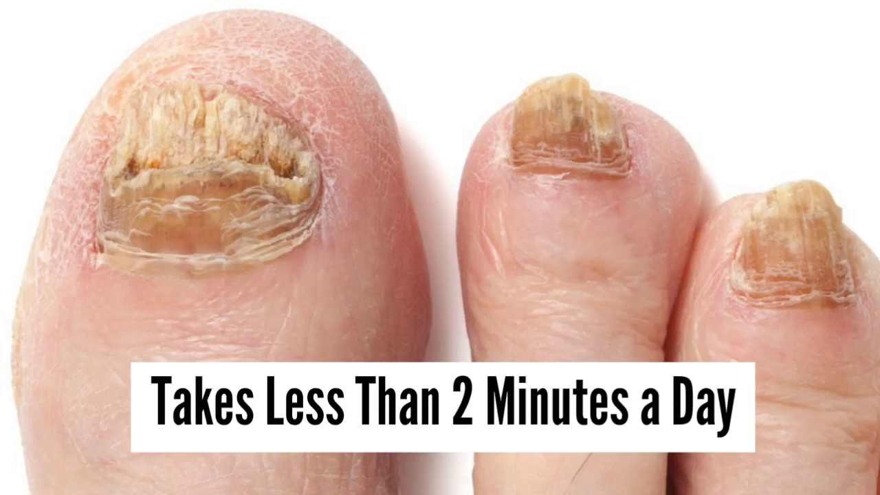 TEA TREE OIL FOR TOENAIL FUNGUS and TOENAIL FUNGUS VINEGAR TREATMENT