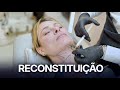 Reconstituição de Toxina + Bioestimulador no Pescoço