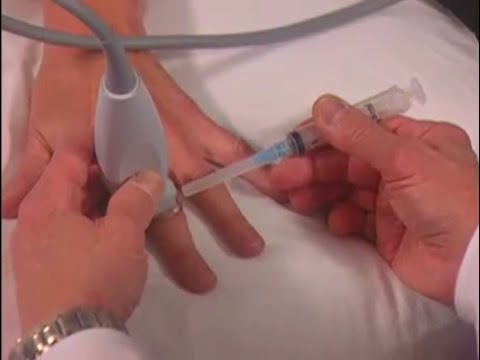 Image of How To: Ultrasound-Guided Hand Injection Scanning Technique Video